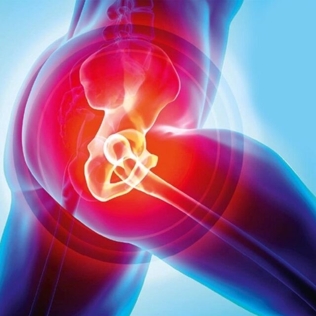 What Is The Cost of Hip Replacement Surgery In India?