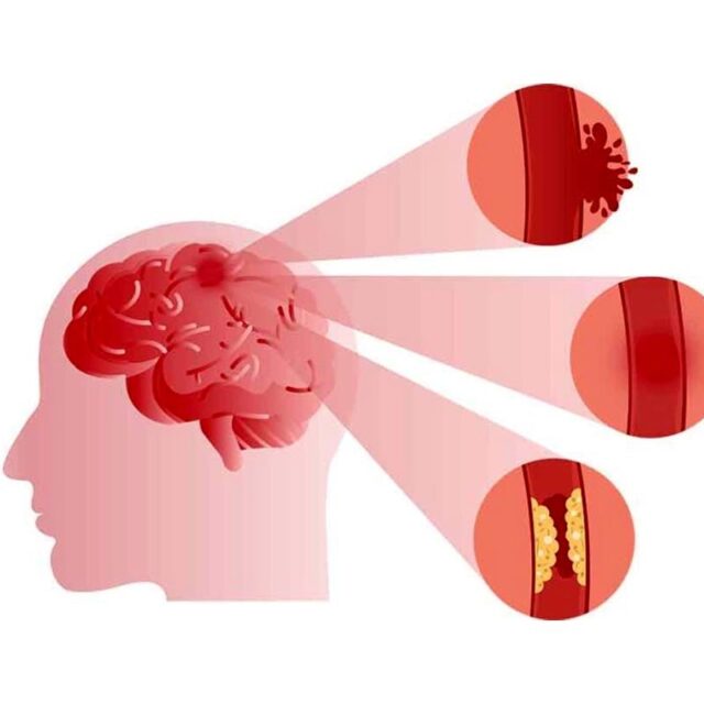 Stroke: Causes, Symptoms, Types, Treatment & More