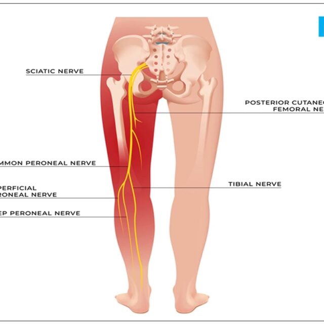 Sciatica: Causes, Symptoms, Diagnosis, Treatment, Risks And More
