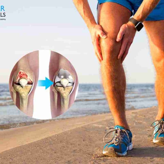 Do’s And Don’ts After Knee Replacement Surgery