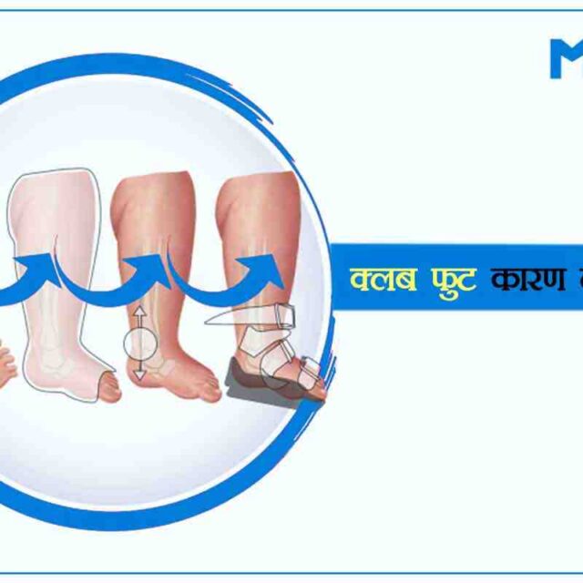 क्लब फुट-जानें इस परिस्थिति के बारे में कुछ महत्वपूर्ण बातें